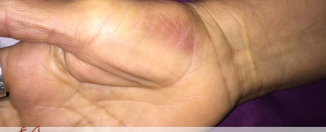 Herido en el Trabajo | Abogado Javier Marcos | 713.999.4444